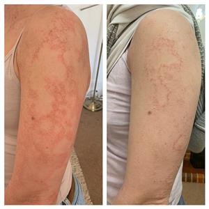 Fungal Infection Treatment in Homeopathy